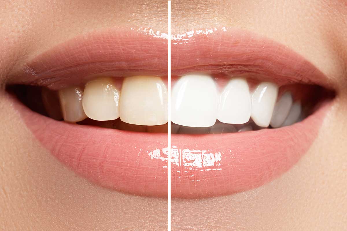 teeth whitening anderson