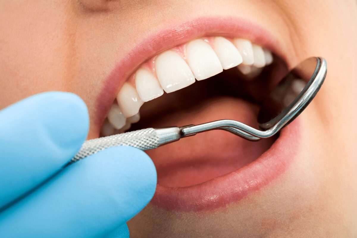 dental fillings anderson