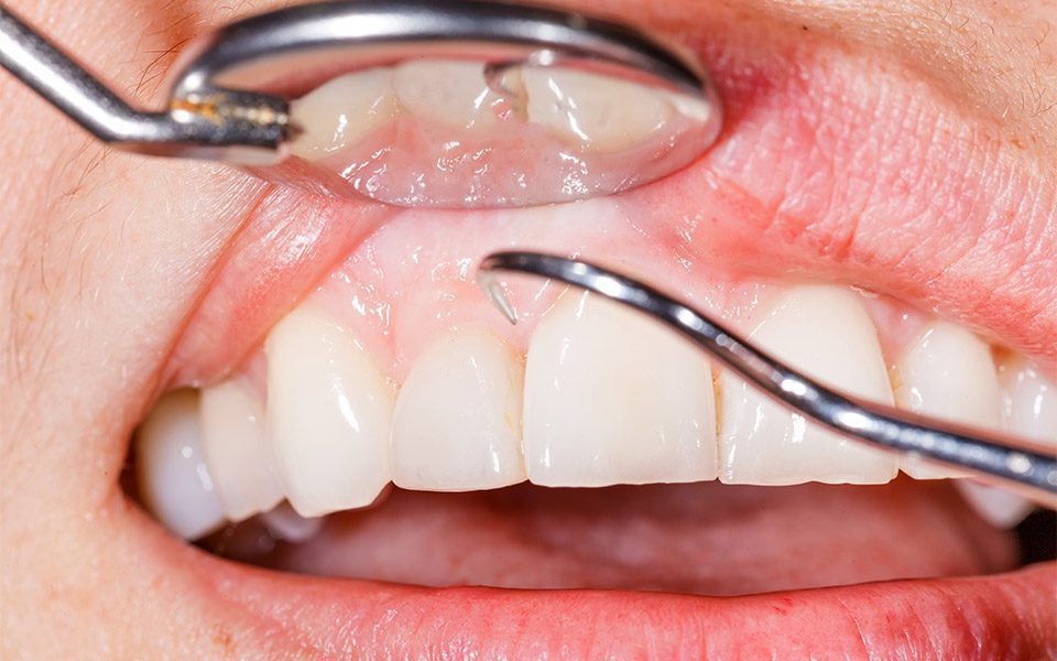 gum disease treatments anderson