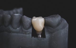 Dental implant in black and white