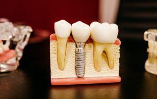 Dental implant