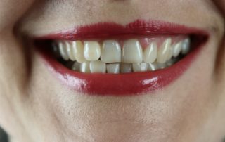 woman smiling with crooked teeth