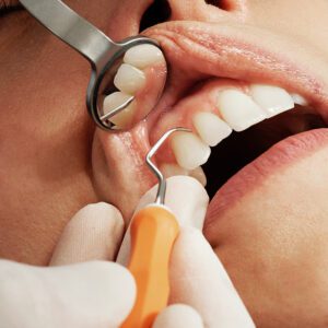 dentist cleaning between teeth