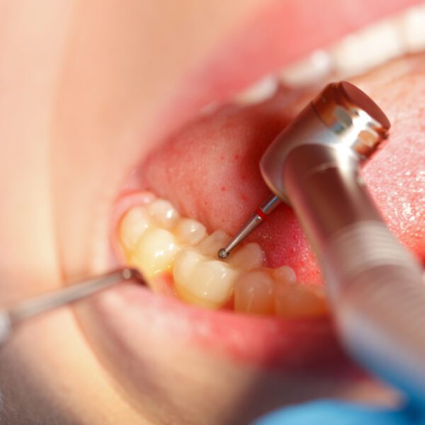 5 Common Dental Cleaning Tools Advanced Indiana