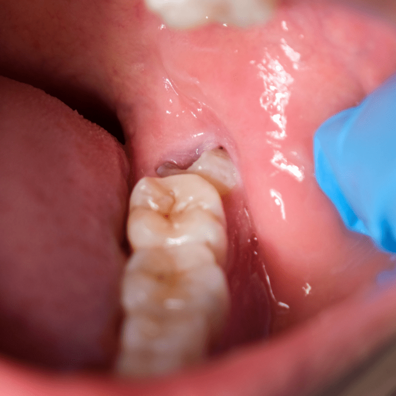 impacted wisdom tooth damage to neighboring teeth and gum tissues