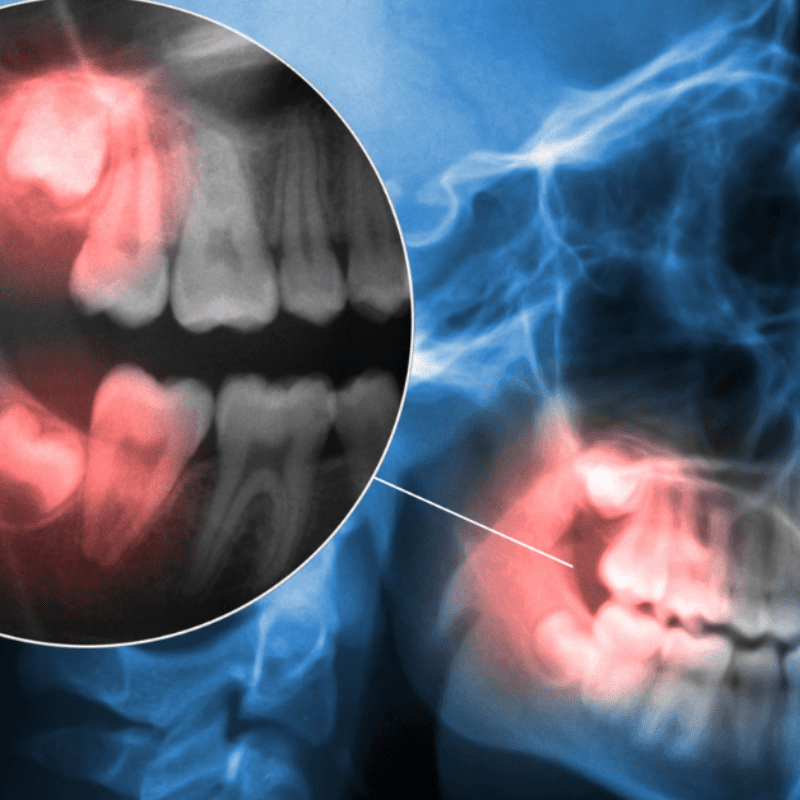 x-ray scan of tooth pain and joint pain