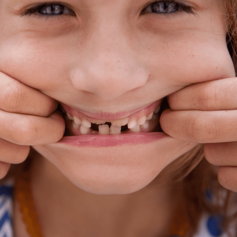 kid shows fractured teeth and signs of bruxism
